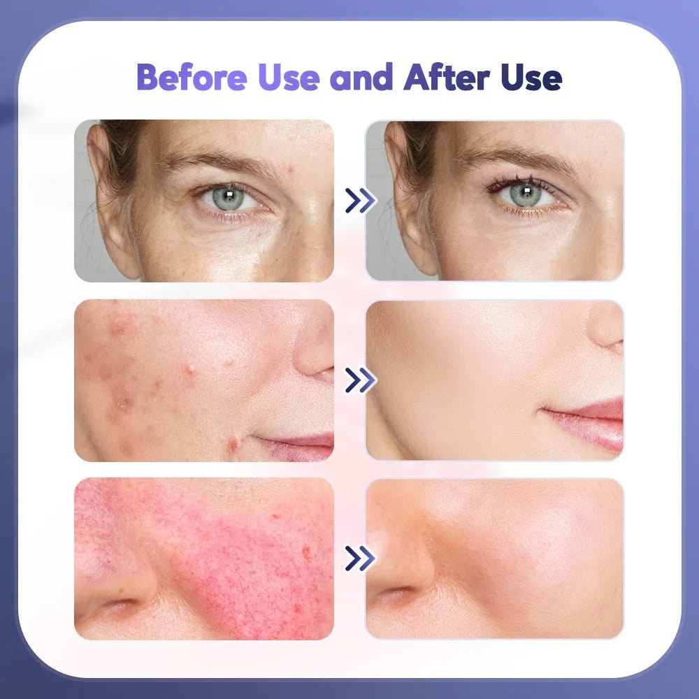 Foreverlily Facial Beauty Massager Skin Lifting Brightening Body Machine - TRENSET
